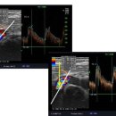 경동맥 초음파: Doppler angle, Artifact 이미지