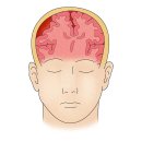 자발성 두개강 내 출혈[Spontaneous intracranial hemorrhage] 이미지