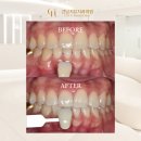 역삼1-139 | 역삼역치과, 강남치유치과 치아 미백 실제 환자 후기와 궁금증 파해치기