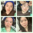클리어비치 | 압구정로데오피부과 청담피부과 큐어트라와 울트라클리어, 쥬베룩 스킨부스터로 흉터치료 시술받은 후기
