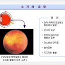 유리체출혈(초자체출혈) 이미지