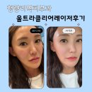 청량리역 피부과 울트라클리어레이저 만족도 대박 후기 !