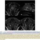 머리뼈와 척추에 발생한 osteosarcoma의 MRI 상 특징 이미지