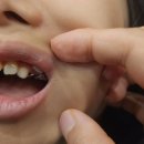 이튼치과의원 | 양주 옥정어린이치과, 이튼튼소아치과 다녀 온 후기-4(공간유지장치 제거)