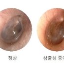 중이염 및 원인 통증 전염 유무 열 약 : 성인 아기 이미지