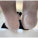 군포종합약국 | 산본무좀발, 무좀으로 고민 많던 남편 드디어 해결책을 찾았어요!