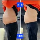 가온피엠씨 | ISW 복부관리 후기
