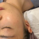 대구자연한의원 | 대구 편평사마귀제거한의원 편평사마귀치료 후기