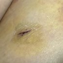 [안산병원] 삼성 건강 하지 외과 의원: 하지 정맥류 레이저 수술 후기