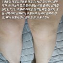 2023. 7.11. 무릎이 아작날 것처럼 며칠 전부터 오늘 새벽까지 심하더니 무릎부터 허벅지 근육과 관절, 뼈가 뒤틀리면서 끊어질 듯 이미지