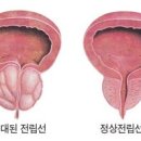 전립선비대증 이미지