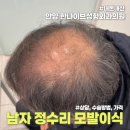 뉴헤어모발성형외과의원 | 아빠 정수리 모발 이식 내돈내산 후기(1) - 병원 상담, 가격, 수술 방법 등