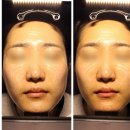 화성 병점 피부관리 미랑 윤곽관리 후기 (하이푸와 물방울리프팅)