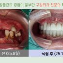 엠비씨(MBC)치과기공소 네이버블로그