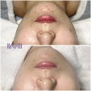 케이엠(주) | 마곡피부관리실 케이엠, 하이푸리프팅