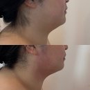 한마음슈퍼 | 서산피부관리 석림동 슬림젯 솔직후기“루아뷰티”💆🏻‍♀️