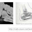 발 뒷꿈치 통증 (Heel Spur) 이미지