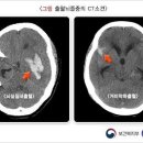 특정 외상성 뇌손상 분류표[별표-상해관련8] 이미지