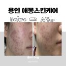 2391 | 수지피부관리 애몽스킨케어 / 1:1 맞춤 여드름 관리, 여드름 요철 5일 만에 박멸한 후기(비포에프터)