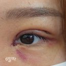 진해로약국 | 큰 시야로 세상을 바라보자 part2. :: 부산 서면 쌍수 쌍꺼풀 눈매교정 앞트임 후기 1~8일차 내돈내산 ::