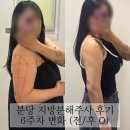 지방분해주사후기 6주차 라인 변화 공개 전후 차이 솔직 리뷰
