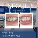 서울자연이치과 | 서울 구의역 치과 치아미백 원데이로 받아본 누렁니 톤업 후기
