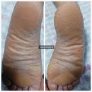 풋라인 | 무좀 발각질 관리받은 후기 가정동 루원시티 발 전문점 - [풋라인]