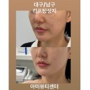 노아뷰티연구센터 | [내돈내산] 대구 신부관리 리프팅 성지 아미뷰티센터 티리온X 2회차 끌어올려!!