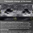 Fibrocystic change of the breast 이미지