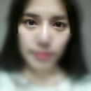 미고성형외과 | ♡비절개눈매교정 후기♡ 미고성형외과에서 비절개눈매교정 만족 후기