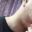 이든코스메틱 | 순하고 촉촉한 청소년 남자 여드름 화장품 추천할게요