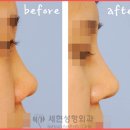 세현성형외과 | 코끝성형후기 딱마음에들어 [세현성형외과]