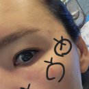 가인의원 | [내돈내산] 30년 이중턱 탈출기! 동성로 J의원 슈링크 500샷 솔직후기 💉✨