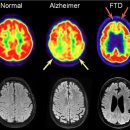 Dementia 이미지