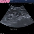 [신장초음파] Multiple parapelvic cyst vs Hydronephrosis 이미지