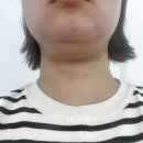 멍앤미 | 신사 뷰티앤영의원에서 뷰컷주사+온다6만줄로 이중턱 삭제한 후기