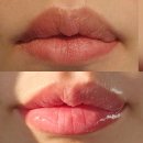 국산1로 | 의정부피부과 입술필러 국산1cc 후기 붓기