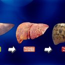 지방간의 진단과 관리 이미지