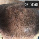 탈모야안녕 | 탈모 샴푸 추천 두피 진정 보습 해파 올인원 샴푸 꾸준히 사용 후기