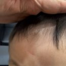 제나성형외과의원 | 이마 열상 봉합 후기 '분당 한땀 성형외과'