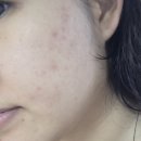 구원메디 | 딱딱한 속드름 박멸! 트러블+수부지 피부를 구원해 준 메디테라피 젠틀 부스트 키트, PDRN 찐 정착 후기...