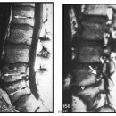 요추와 디스크, 연관조직의 퇴행성 변화를 관찰한 MRI 소견에 대하여 이미지