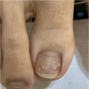 닥터아이티엔 네일의아침 대전서구점 | 대전서구무좀발톱 건강하게 해결해 준 네일의아침 내성발톱 무좀 발각질 네일 문제성발