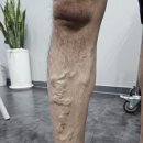 김진호내과의원 | 하지정맥류 치료후기