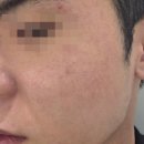 평화한의원 | 강남여드름한의원 남자 흉터치료 모공흉터 패인흉터 치료 후기