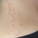 진주메디칼 | 진주 하얀메디컬 대상 포진 치료 후기 (완치O, 흉짐아직O) - 2편