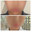 신사역피부과 에이브의원 인모드로 이중턱 고민 해결한 후기