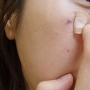 하나성형외과의원 | 여자 얼굴 피지낭종 : 오체안성형외과의원 (모기질종 제거 비용/ 보험 후기)