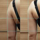 후엔인천 | 팔 무한람스 3개월 | 변화없음 재시술확정 인천 람스 후관리 솔직후기