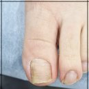 서울신내의원 | 구리내성발톱 수술없는 빠른 관리후기